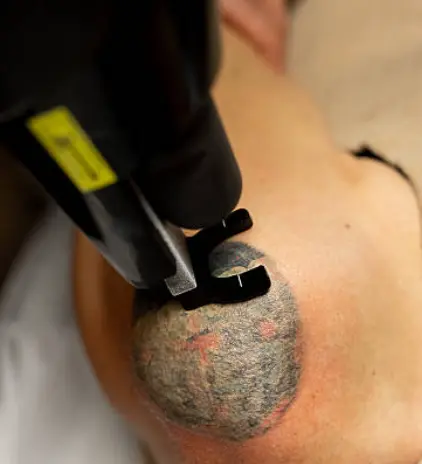 Borrado de tatuaje 4